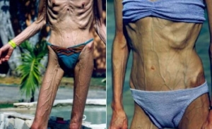 Anorexia, o boala psihica, afecteaza fotomodele si vedete din toata lumea