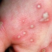 Psoriazisul, o afectiune cutanata cronica