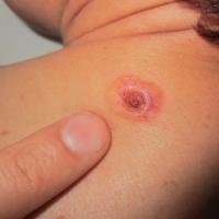 Campanie dedicata exclusiv consultatiilor gratuite, pentru elevi, de EuroMelanoma Day