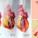 Cum sa eviti sa faci hipertensiune arteriala