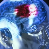 Simptomele accidentului vascular cerebral