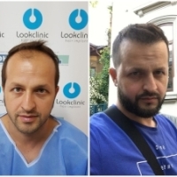 Cum arata actorul Razvan Oprea, la zece luni de la implantul de par!