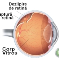 Interviu cu medicul oftalmolog Babara Stela Efimovna: Dezlipirea de retina - o boala periculoasa