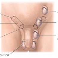 UN NEOPLASM BENIGN: HERNIA INGHINALA