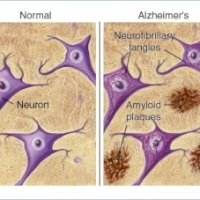 Simptome ale bolii Alzheimer