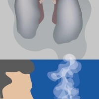 Cancerele pulmonare si cele renale sunt descoperite in ultimele stadii