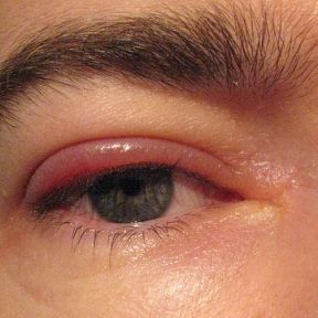 Inflamarea ochilor