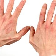 29 octombrie, Ziua Mondiala a Psoriazisului