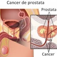 Cancerul care se extinde dincolo de tesutul prostatic nu poate fi vindecat
