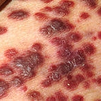 Sarcomul Kaposi, un tip de cancer care se dezvolta din celulele endoteliale