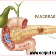 Cancerul de pancreas, una dintre cele mai perfide afectiuni maligne