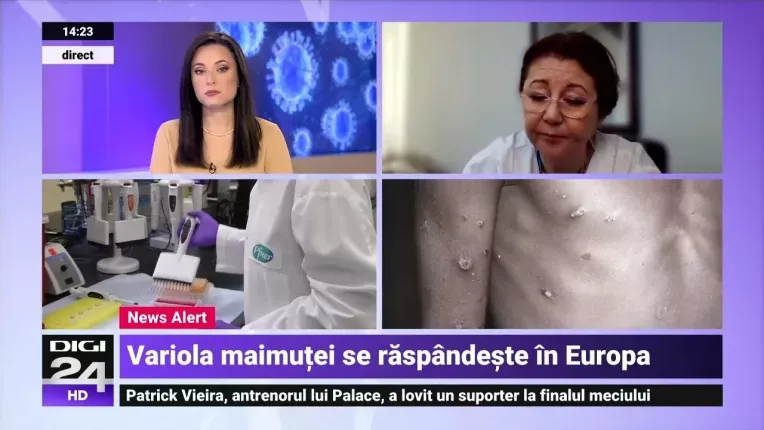 Care sunt simptomele si cum se transmite variola maimutei, noul virus care se raspandeste